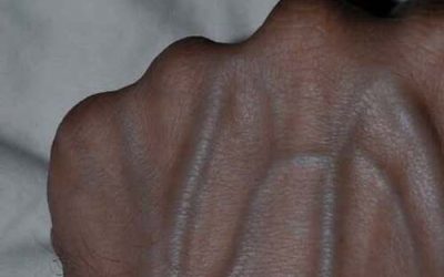 If the veins on your arm are visibly prominent, this is :A: signal that