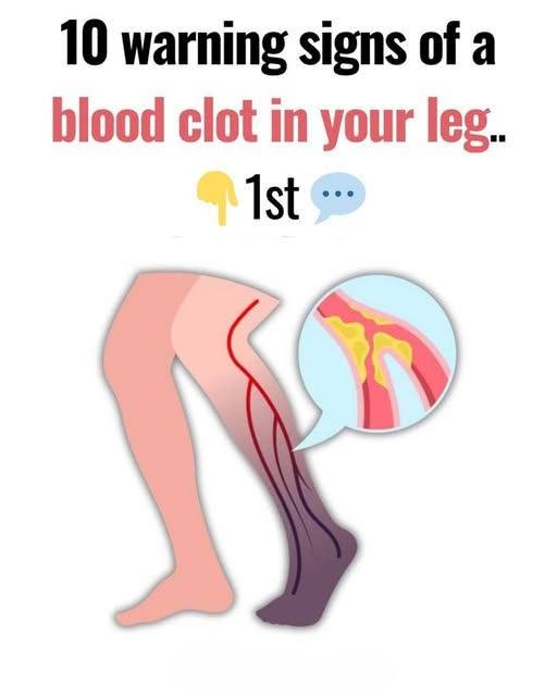 10 Warning Signs of a Blood Clot in the Leg You Should Know