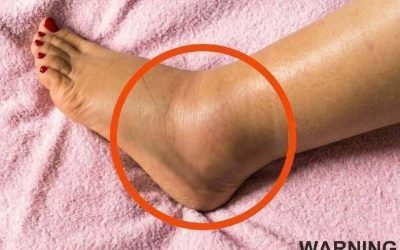 If You Notice Your Legs Are Swollen, Doctors Warn It Could Be a Sign of