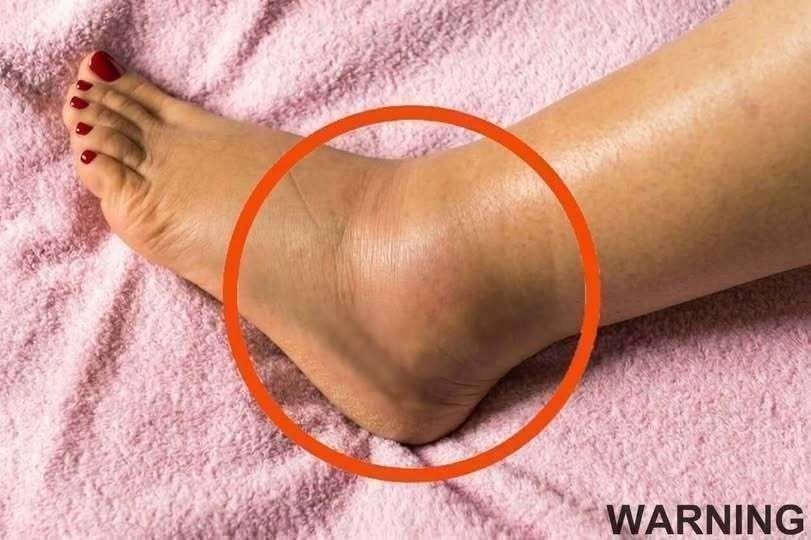 If You Notice Your Legs Are Swollen, Doctors Warn It Could Be a Sign of