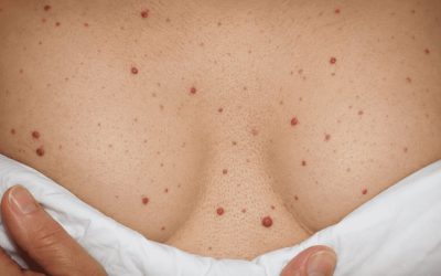 Recipe What are the red spots that appear on the skin?