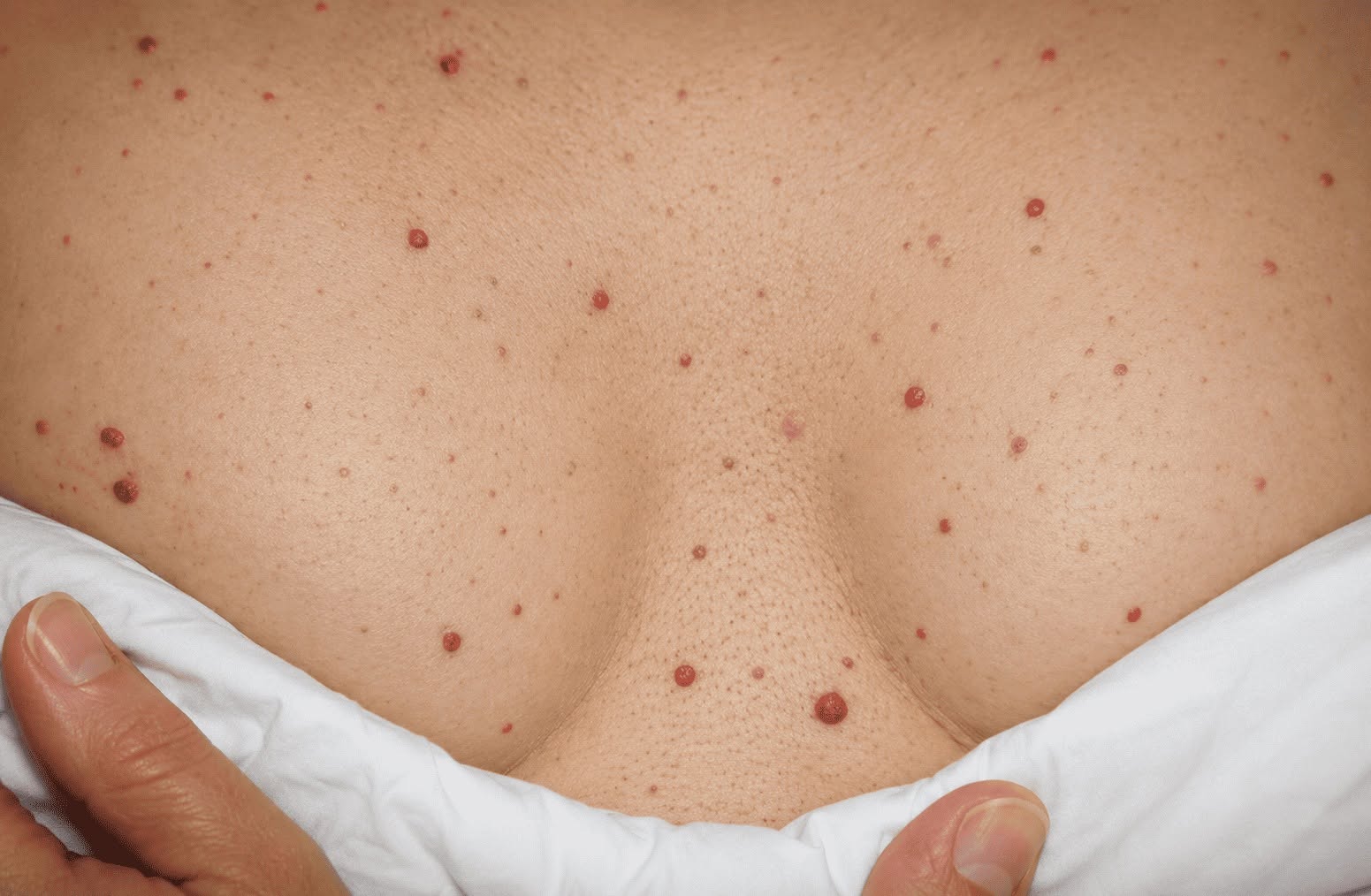 Recipe What are the red spots that appear on the skin?