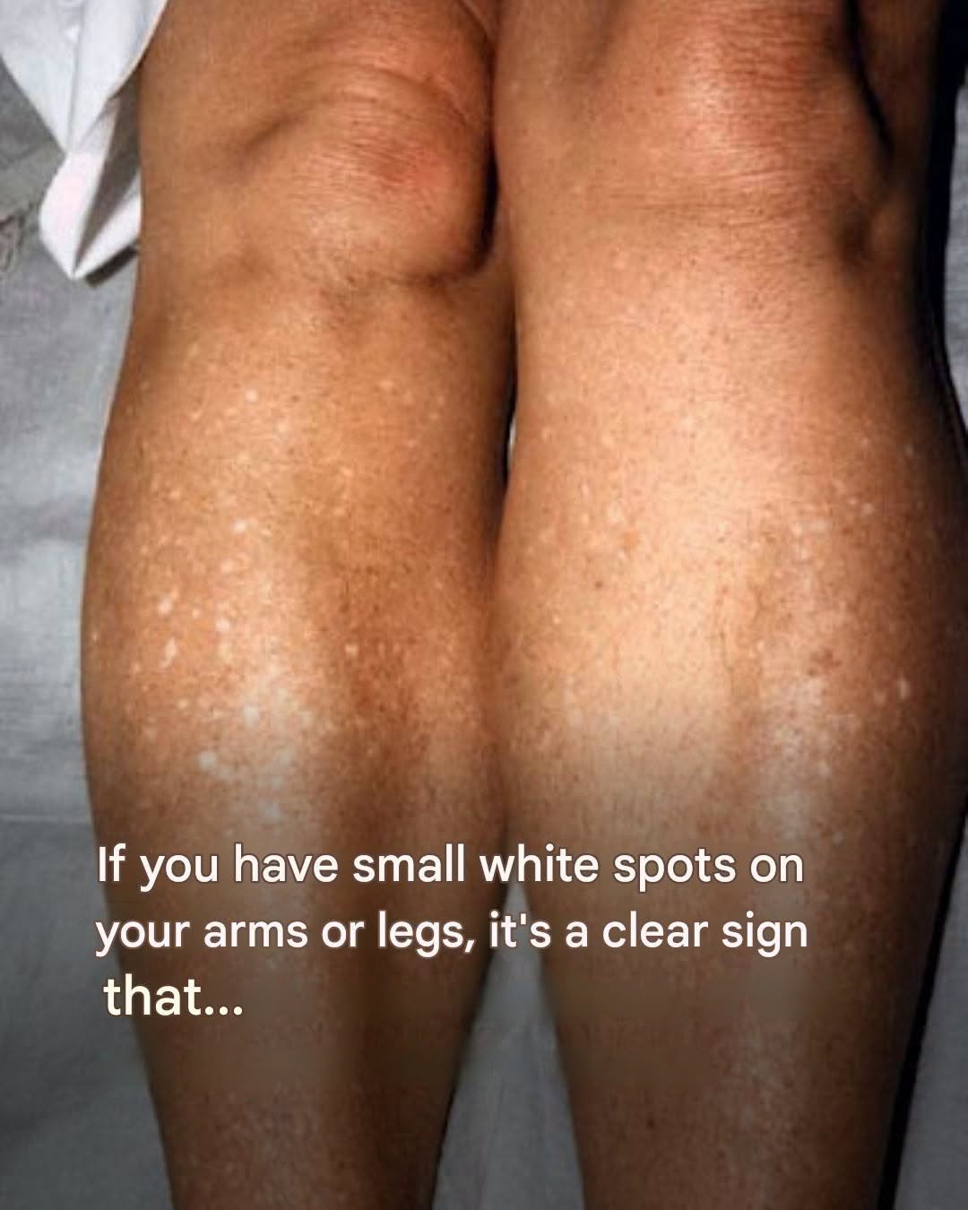 Why do I get white spots on my skin in the summer and how can I treat them? A dermatologist answers.