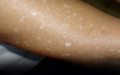 Have You Noticed Small White Spots on Your Arms or Legs? Here’s What They Are1