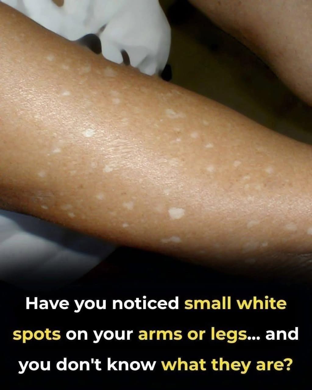 Have You Noticed Small White Spots on Your Arms or Legs? Here’s What They Are1